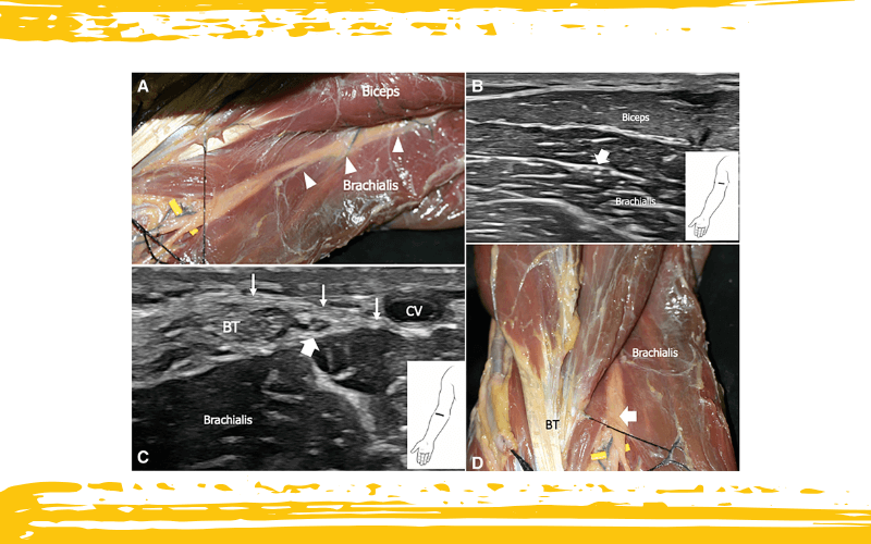 2. Nervio cutáneo lateral antebrazo.png